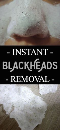 How To Remove Nasty Blackheads Instantly