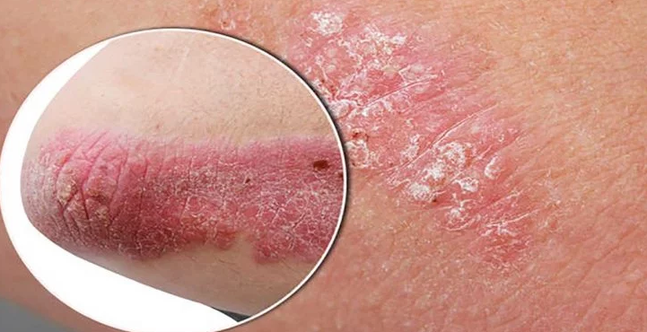 This Natural Tip Removes Psoriasis, Fungi, Herpes, Acne And Much More