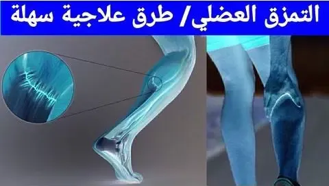 أسباب الشد العضلي والتمزق العضلي