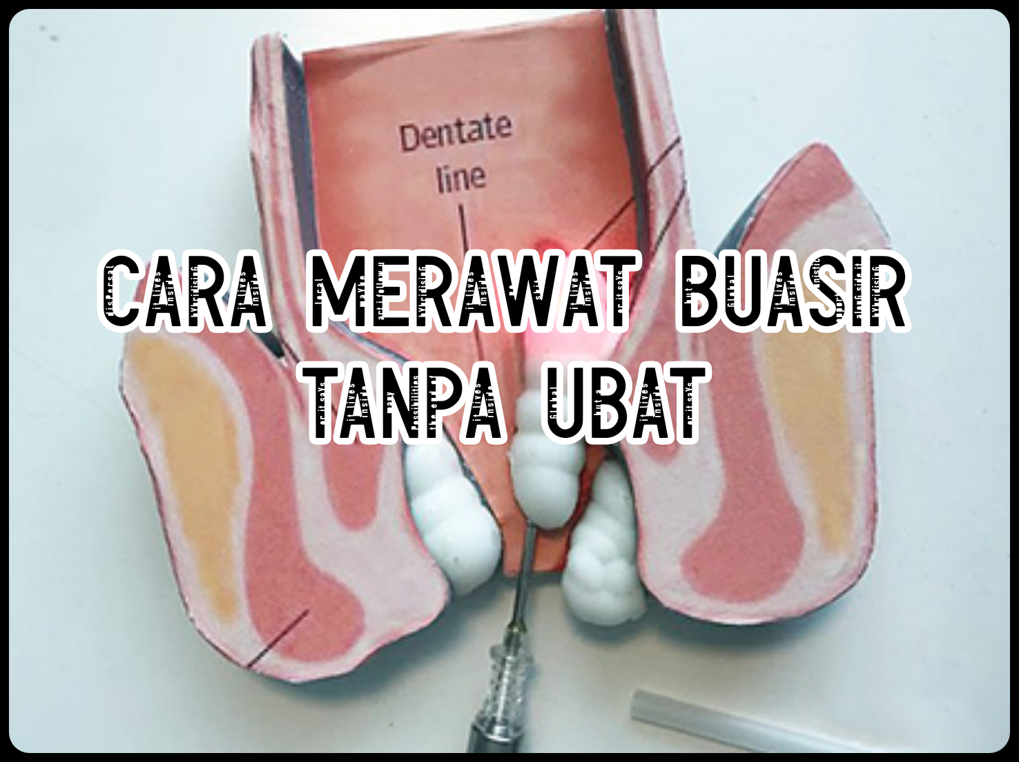 Tips dan Pengalaman Cara Merawat Buasir Luaran Secara 