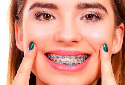 Phương pháp niềng răng mắc cài kim loại 