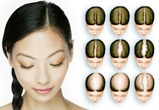 Tipos de alopecia en mujeres parte I