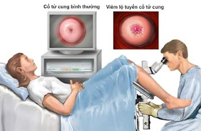 Cách điều trị viêm lộ tuyến cổ tử cung