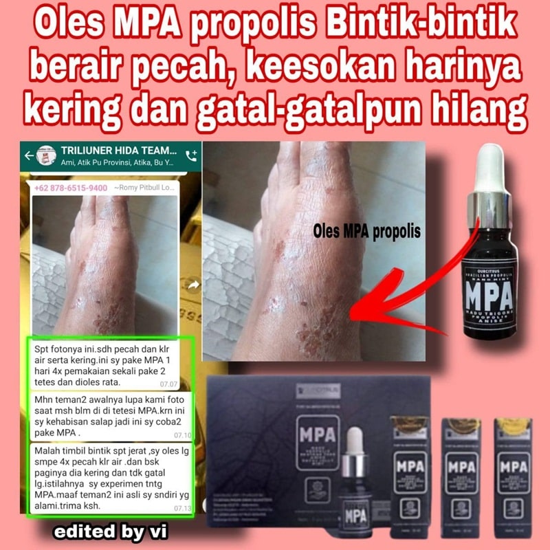 kulit gatal dan iritasi sembuh dengan mpa propolis