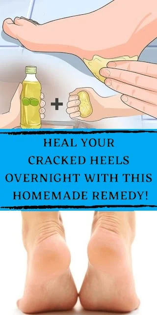 Say Stop To Your Cracked Heels With This Amazing Homemade Remedy! 