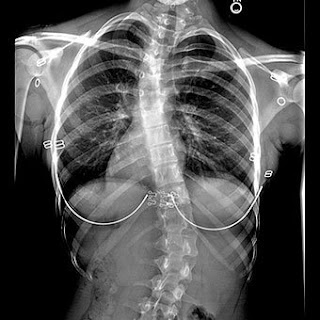 Scoliosis