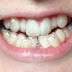 Ưu điểm niềng răng invisalign là gì?