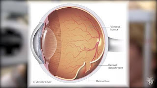 Pharmacotherapy of retina detachment