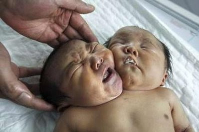 conjoined twins born in China on May 5, 2011