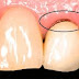 Có nên gắn lại răng sứ khi răng bị bung tuột?