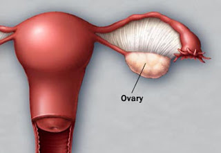  Causes and effects of oophorectomy for women