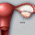  Causes and effects of oophorectomy for women