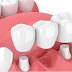 Cầu răng sứ dùng để làm gì?