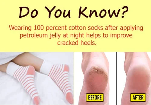 How To Fix Cracked Heels Permanently - DIY Cracked Heels