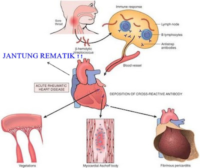 Penyebab Demam Rematik dan Jantung Rematik Serta Pengobatannya