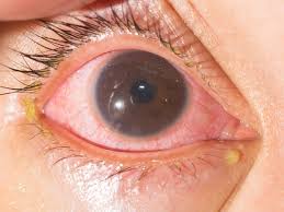 Uveitis: Causes, Symptoms, and Treatment Options