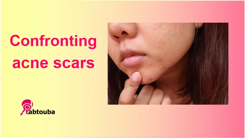 Confronting acne scars