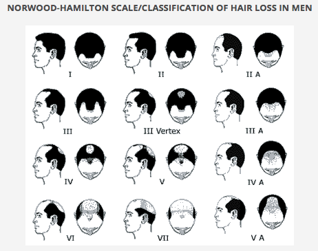 FUE hair transplant malaysia