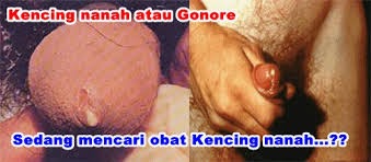 kencing nanah