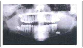 Ameloblastoma Adalah