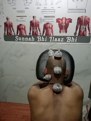 Hijama Cupping For Insomnia