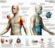 Dengue. Dez dicas contra a dengue. Veja o que fazer para eliminar as . (classica)