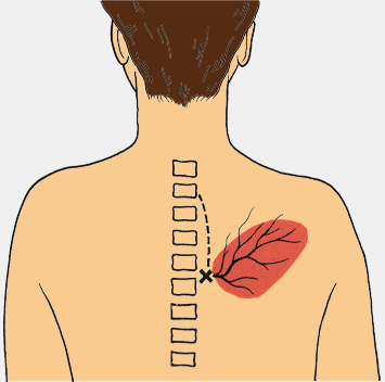 355 x 352 gif 19kB sciatica piriformis brachialgia dorsalgia