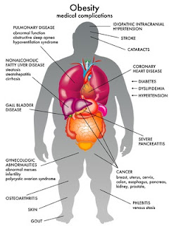 tratamiento de la obesidad y sobrepeso en sevilla balón intragástrico y método apollo