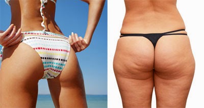 rimedi naturali contro la cellulite