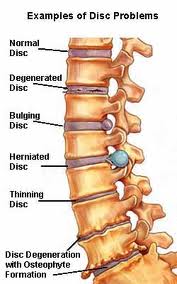 Degenerative Disc Disease Treatment in  Chennai