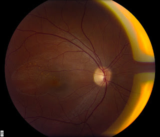   achromatopsie, achromatopsie définition, complete achromatopsia, achromatopsia causes, achromatopsia symptoms, achromatopsia vs color blindness, monochromacy, achromatopsia glasses, achromatopsia treatment