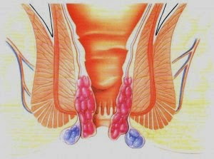 Gambar Bagi Penyakit Ambeien Atau Wasir