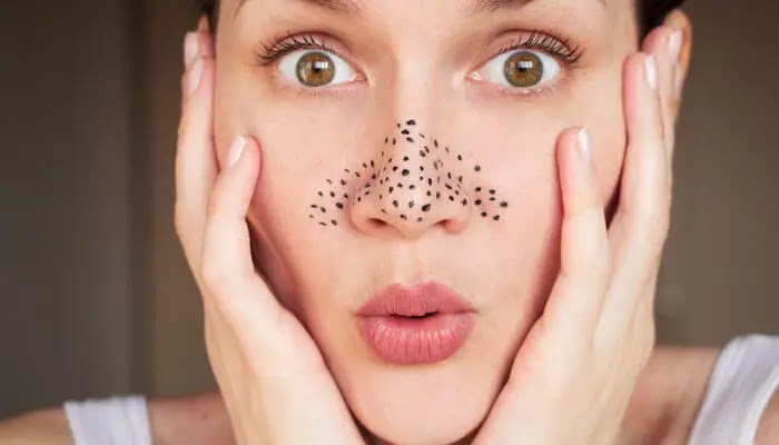 To get rid of blackheads naturally ... Here are these masks