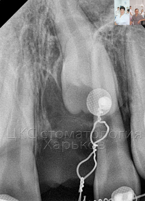 рентген ретинированного зуба после операции