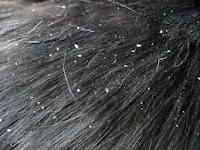 Causes of Hair Dandruff