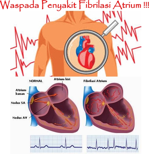Pengobatan Tradisional Fibrilasi Atrium