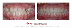 Orthodontic Treatment of Dental Crossbite, Lawrenceville GA 30043