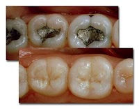 Mercury Fillings 