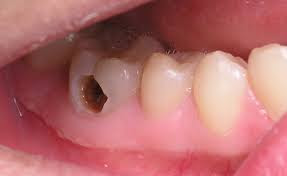 Trám răng sâu-Cách chữa sâu răng VĨNH VIỄN không tái phát