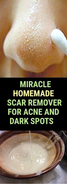 Miracle Homemade Scar Remover For Acne And Dark Spots