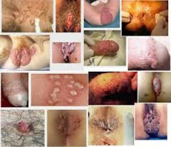 penyakit ketuat atau kutil dikemaluan kelamin / di area dubur / anus / benjolan / kondiloma akuminata / jengger ayam pada pria dan wanita
