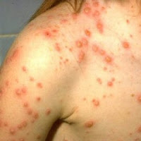 chickenpox