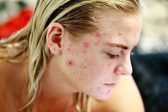 Beautiful girl with bad acne