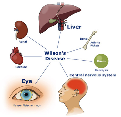 Ayurvedic Treatment For Wilson disease - Dr. Vikram's Blog - Ayurvedic