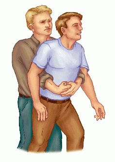 heimlich maneuver image