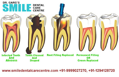 Painless Root Canal Treatment