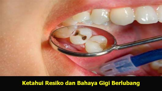 Ketahui Resiko dan Bahaya Gigi Berlubang