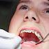 Răng khôn có nên nhổ khi niềng răng?