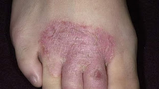 Penyakit Kulit Gatal Eksim Menular Tidak, Penyakit Kulit Eksim Dermatitis, Gatal Di Selangkangan Jangan Digaruk, Ramuan Alami Mengobati Gatal Eksim, Obat Penyakit Gatal Pada Kaki, Artikel Penyakit Kulit Eksim, Obat Gatal Pada Kulit Karena Kutu, Obat Eksim Kering Yang Ada Di Apotik, Penyakit Kulit Gatal Eksim Apakah Menular, Obat Gatal Kulit.Com, Obat Gatal Hidrokortison, Resep Gatal Eksim Kering, Obat Gatal Eksim Menurut Dokter, Obat Gatal Gatal Karena Kuman, Obat Gatal Kulit Di Kaki, Obat Gatal Kemaluan Pria Di Apotik, Obat Gatal Kepala Alami, Mengobati Eksim Susu Pada Bayi, Obat Gatal Diselangkangan Untuk Ibu Hamil, Gatal Eksim Usus, Obat Untuk Kurap Yang Gatal, Gatal Di Telur Kemaluan, Penyakit Kulit Eksim Menahun, Menghilangkan Rasa Gatal Di Selangkangan, Obat Herbal Telinga Gatal Dan Berair