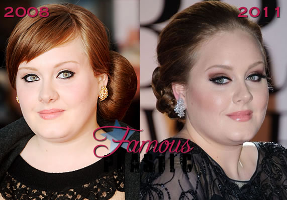 Adele Plastic Surgery Nose Job Before and After